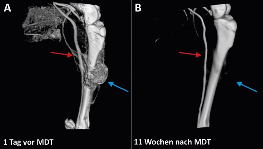 Tumorremission nach MDT